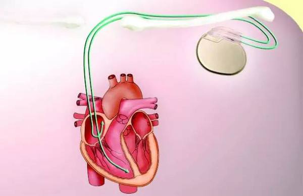 起搏器3類醫(yī)療CE認(rèn)證